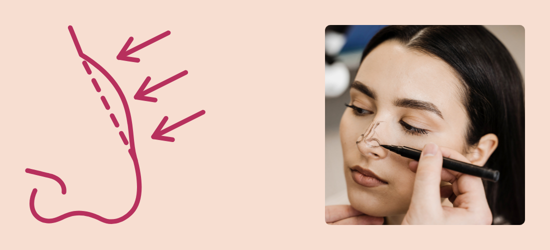 Rhinoplasty (Nose Reshaping) Treatment